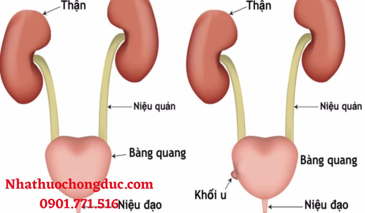 Nguyên nhân nào gây ra ung thư bàng quang?