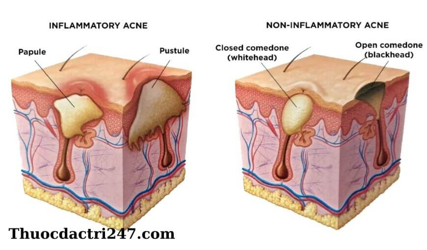 Nguyên nhân gây ra mụn trứng cá? Phuong phap dieu tri mun trung ca hieu qua1