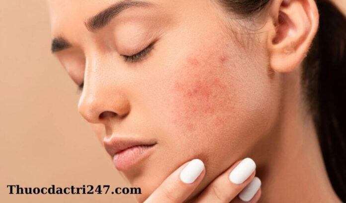 Phương pháp điều trị mụn tốt nhất Phuong phap dieu tri mun trung ca hieu qua2
