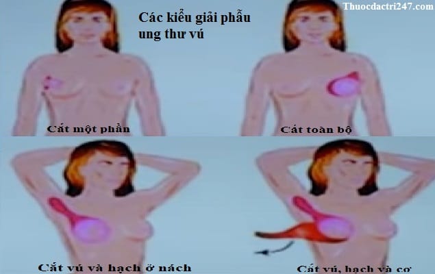 cac kieu giai phau ung thu vu nhu cat mot phan vu, cat toan bo, cat vu va hach o nach, cat vu hach va co